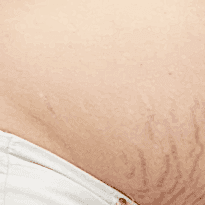 Kayseri Çatlak Tedavisi