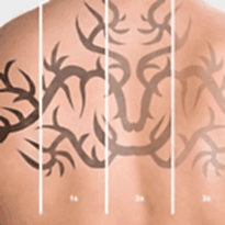 Kayseri Dövme Silme