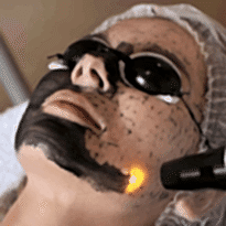 Kayseri Karbon Peeling